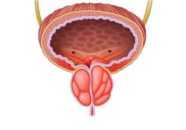 Inflammation of the prostate in men