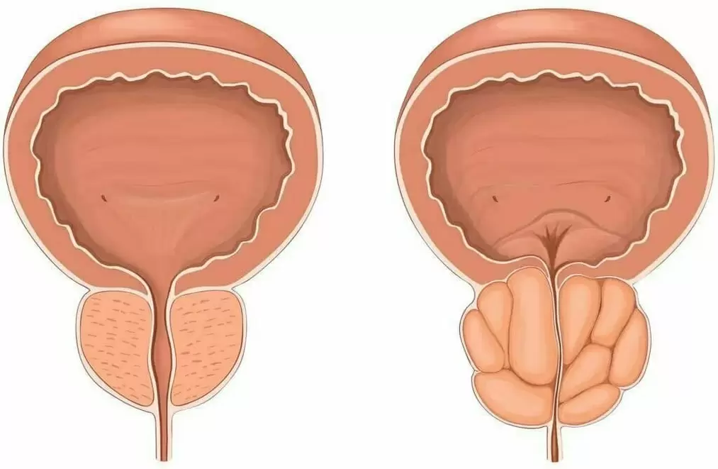 Normal prostate and aching prostate