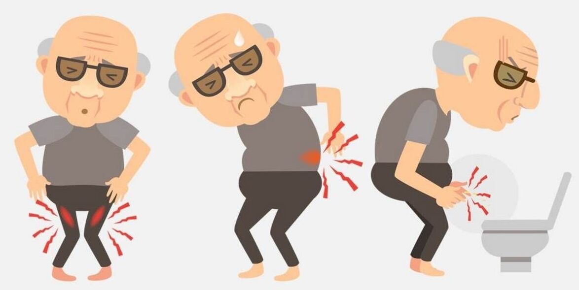 Prostatitis symptoms